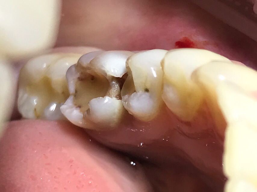 - Лечение и реставрация зуба боковой группы (второй моляр) - фото до.jpg