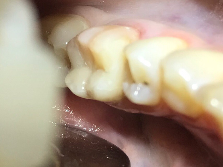 - Лечение и реставрация зуба боковой группы (второй моляр) - фото после.jpg
