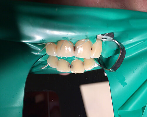 Лечение кариеса верхних передних зубов - фото до (1).jpg