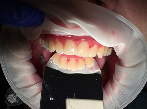 Лечение кариеса верхних передних зубов - фото после (1).jpg